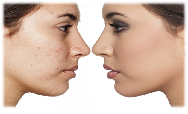 remove dark spots naturally